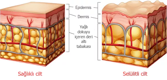 Selülit Nedir? Çaresi Masaj Mat Olabilir Mi?